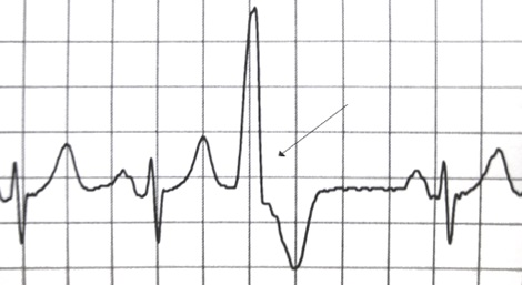 File:A premature ventricular contraction marked by the arrow.jpg