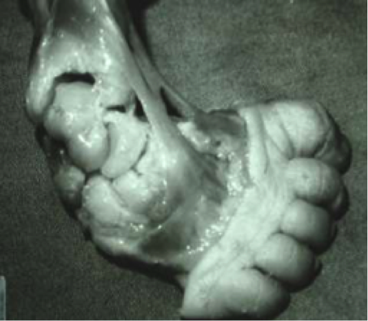 File:Clubfoot4.png