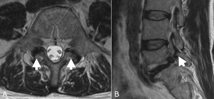 File:MRI image Spondylolysis.jpg