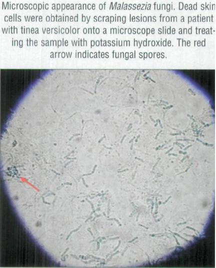 Image:Tinea_Versicolor_Microscope.JPG