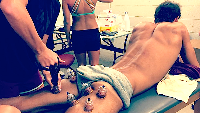 File:Static cupping placement on hamstrings.png