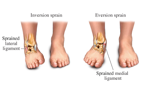Ankle-Sprains.jpg