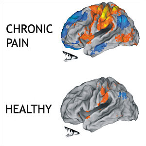 This image shows that there is a much more widespread activation of cortical areas in someone suffering from chronic pain compared to acute pain. Credit: Northwestern University.