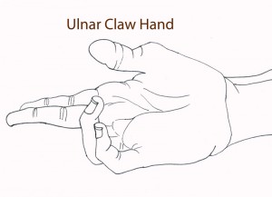 File:Ulnar-Claw-Hand-300x217.jpg