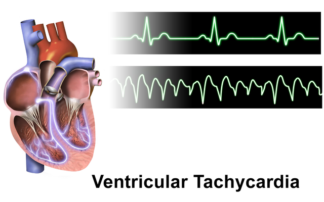 File:Ventricular Tachycardia.png