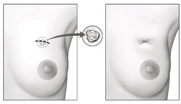 File:Lumpectomy2 group1.png