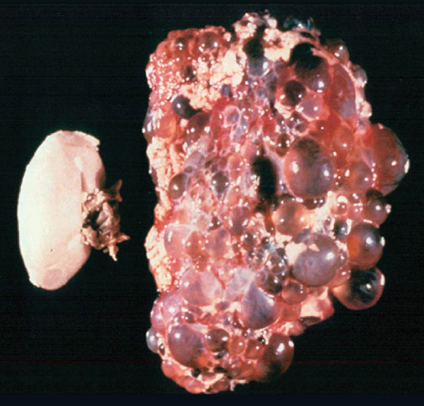 Poly kidney and normal kidney.jpg