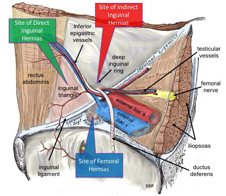 File:Common Sites of Lower Abdominal Hernias.jpg