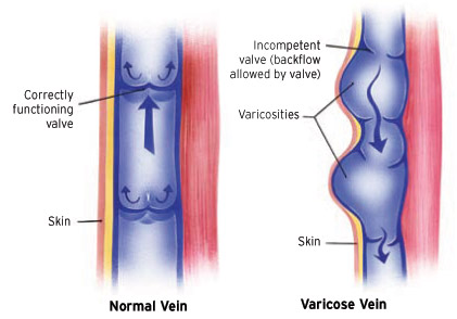 File:Vein Valve Anatomy.jpg
