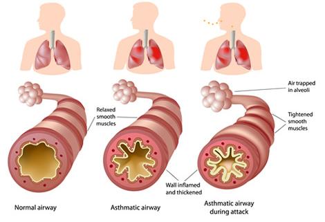 Taken from: http://covenantallergy.com/pages/what_is_asthma.shtml