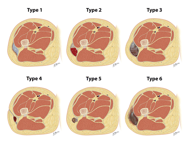 File:MRI type of morel lavallee.png