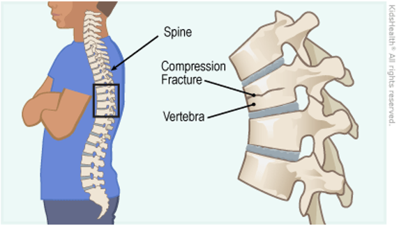 File:Picture to show compression fracture .png