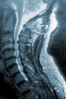 Cervical Spondylosis.jpg
