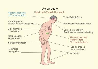Acromegaly comorbidities.jpg