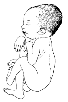 File:Arthrogryposis picture.png