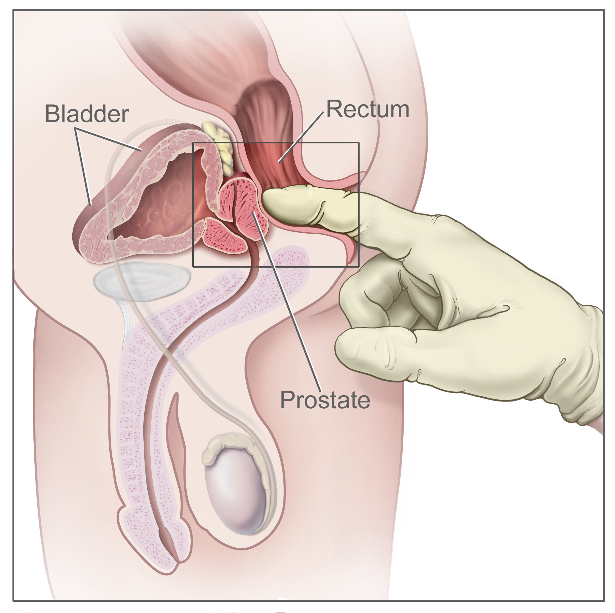 Prostatitis hipertónia