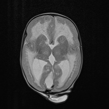 File:Lissencephaly type 2.png