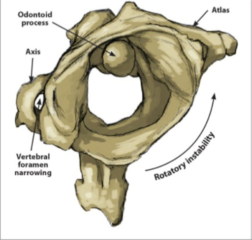 File:Cervical instability anatomy.png