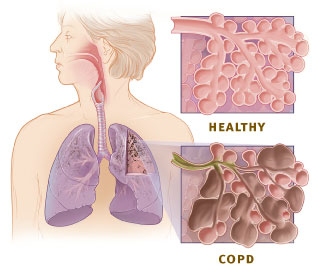File:Copd versus healthy lung.jpeg