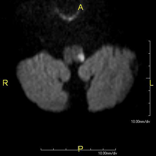 MRI of acute infarct of left dorsal medulla, visible as bright white spot in image