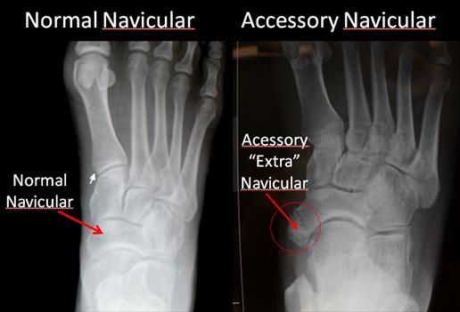 File:Normal-Navicular-and-Accessory-Navicular.jpg