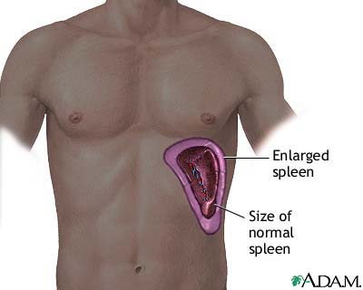 Example of an enlarged spleen in patients with AML.