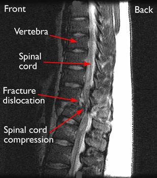 File:Spinal cord compression .jpg