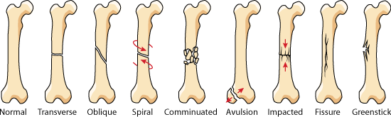 File:Bone fractures.gif