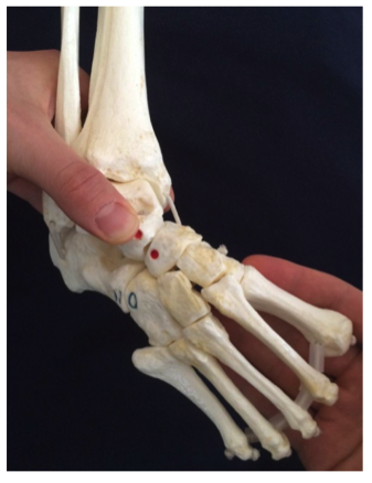 File:Position of Foot during Clubfoot Manipulation.png