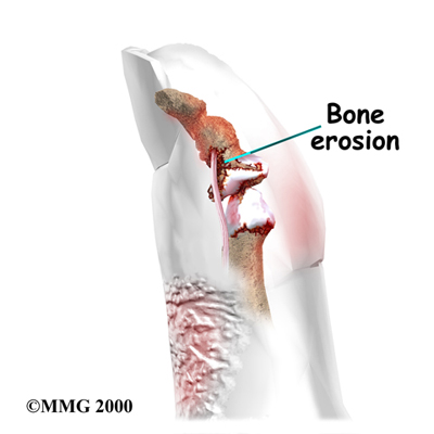 File:Arthritis psoriatic Bone Erosion.jpg