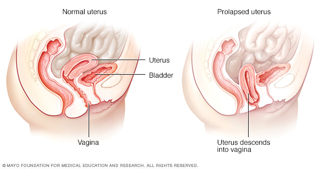 File:Normal and Uterine Prolapse.jpg