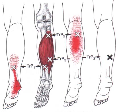 File:Trigger-points-of-the-soleus.jpg