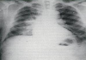 File:Chest X-ray.jpg