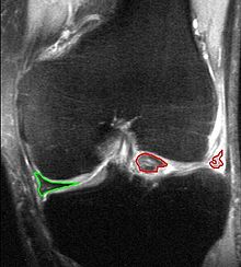 Joint Line Tenderness of the Knee - Physiopedia