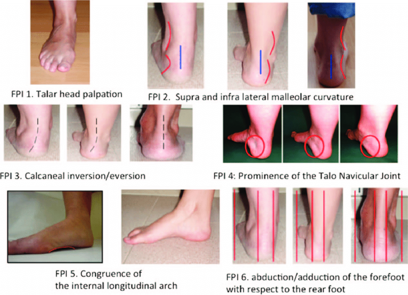 File:Different-measures-of-the-Foot-Posture-Index.png