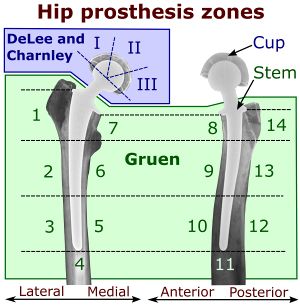 Hip prosthesis zones by DeLee and Charnley system, and Gruen system.jpg