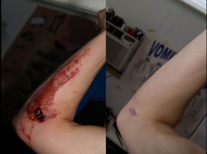 Scar before and after.jpeg