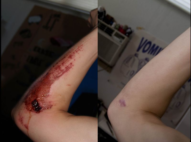 File:Scar before and after.jpeg