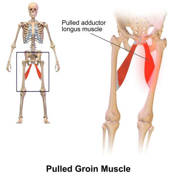 File:Pulled Groin Muscle.png