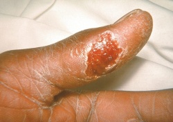 Ulcer on Thumb
