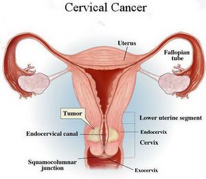 Cervical-Cancer-Picture.jpg