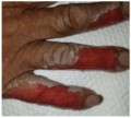 White areas in periwound demonstrate maceration