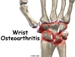 Wrist osteoarthritis intro01.jpg