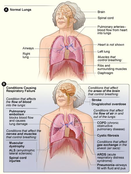 Nursing diagnosis Ineffective breathing pattern