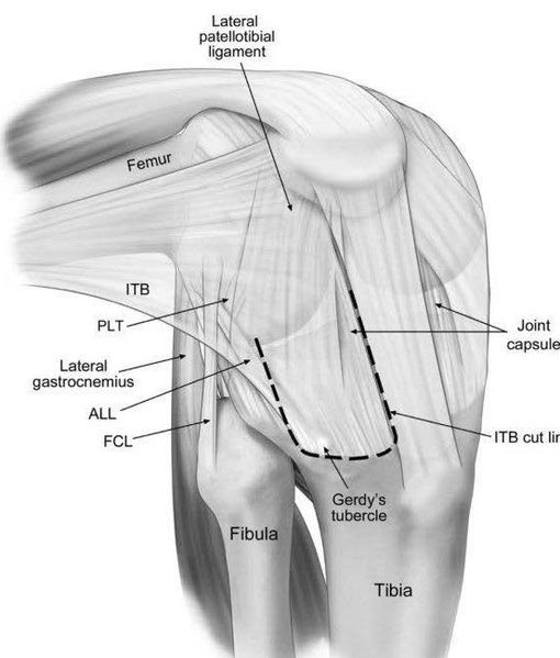 File:Anterolateral-view-of-a-right-knee-showing-the-anterolateral-and-lateral-structures-The W840.jpg