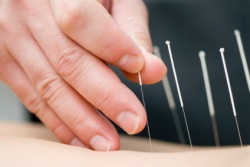 This picture depicts acupuncture therapy that can be used to decrease pain. It was included courtesy of www.googleimages.com.