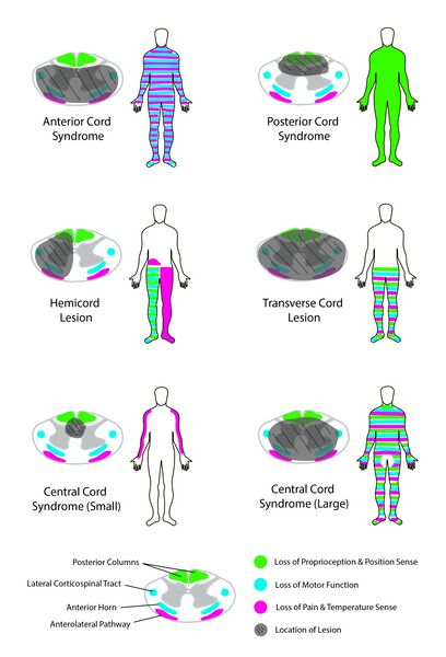 File:Spinal Cord Lesions and Syndromes.jpeg