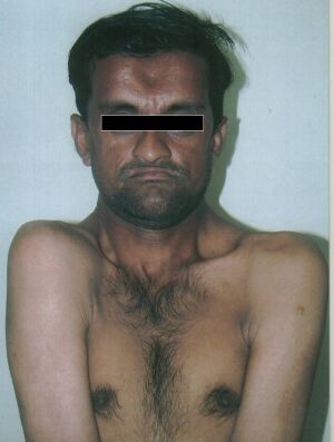Cleidocranial dysplasia face and shoulders.jpg