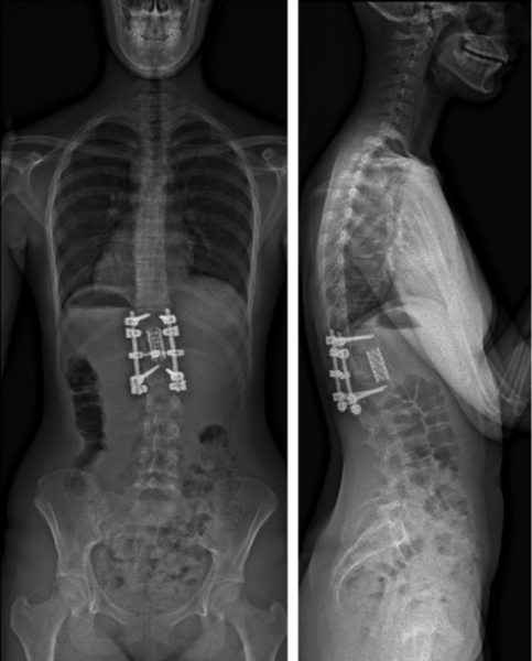 File:Post-operative radiographs after short instrumentation and anterior grafting to treat a burst fracture of T12..png