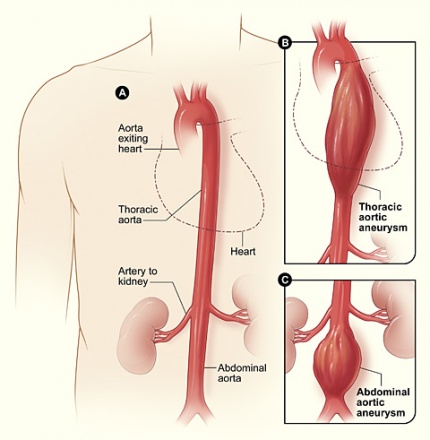define aneurysm rupture)